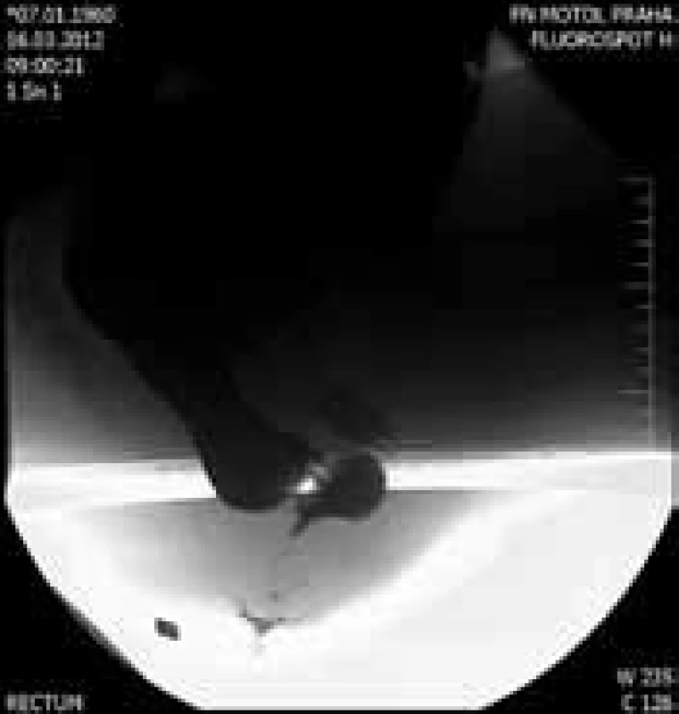 Vyšetření před léčbou – nález ventrální rektokély na defekogramu.
Fig. 1. Investigation before the therapy – rectal prolapse on defecography.