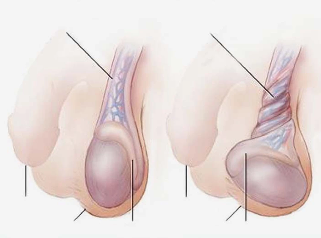 Torze varlete. Zdroj: Mayo foundation for medical education and research