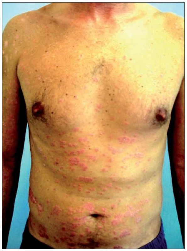 Těžká forma chronické ložiskové psoriázy, selhání konvenční terapie – stav před léčbou etanerceptem