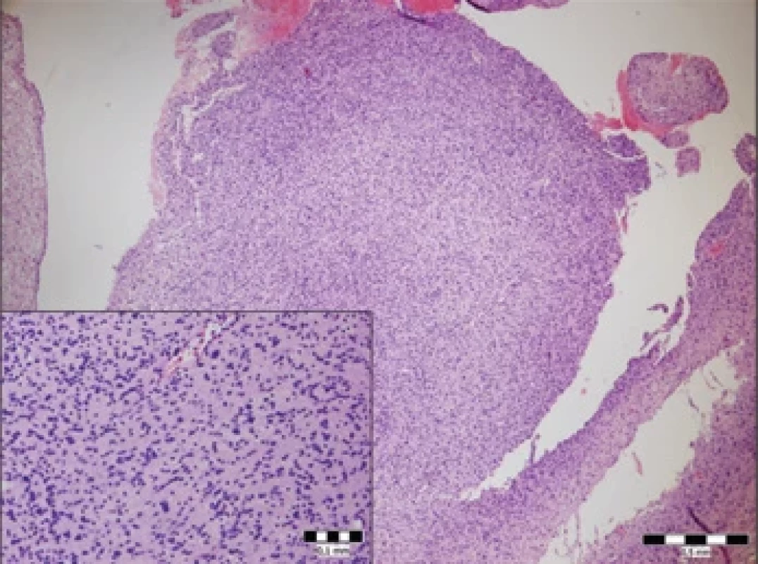 Histopatologické vyšetření – mikrofotografi e 400× zvětšení + ultrastruktura schwannomu, barvení H&E. Histopathological examination – microphotograph 400× magnifi cation + ultrastructure of schwannoma, stained with H&E.