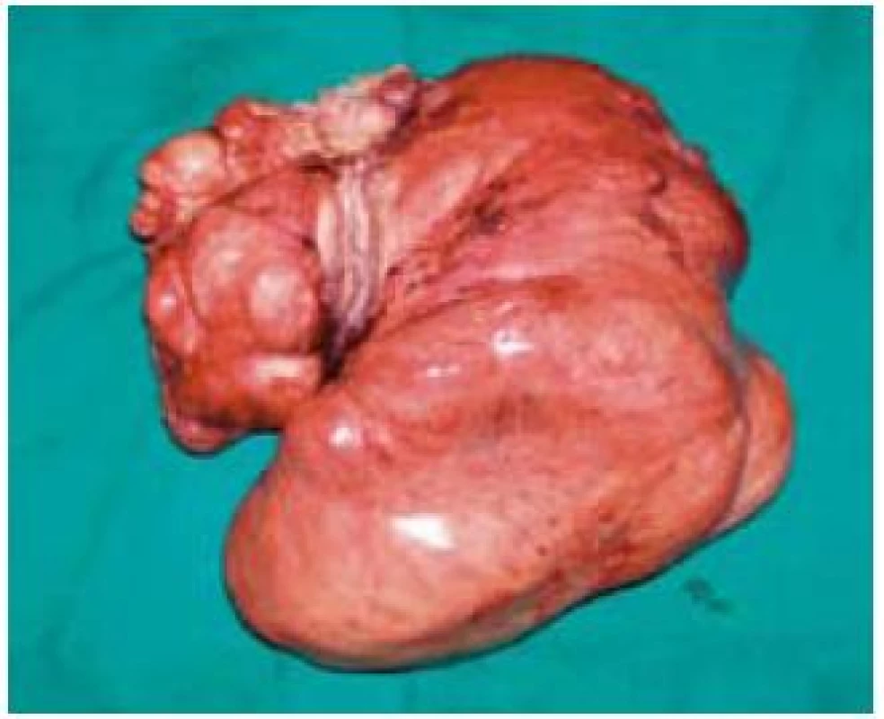Peroperačný resekát tumoru so zavzatými kľučkami tenkého čreva.
Fig. 2. The surgical resection specimen of a tumour with small intestine loops.