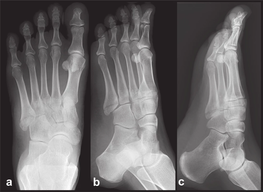 Základní projekce u Jonesovy zlomeniny báze 5. mtt
a – předozadní snímek; b – šikmá (45°) projekce; c – bočná projekce.
Fig. 1: Basic projection in the Jones fracture of the fifth metatarsal base
a – anteroposterior view; b – oblique (45° degree) view; c – lateral view.
