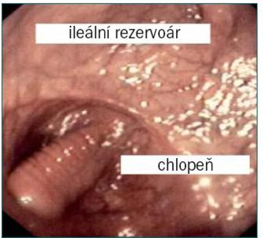 Ileální chlopeň.