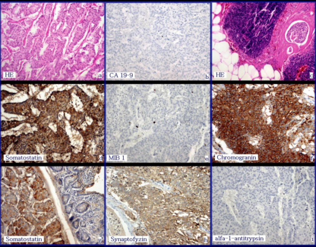 Výběr z histologických vyšetření:
4a – trabekulární úprava nádoru – barvení hematoxylin-eozin.
4b – negativita CA 19-9 – imunohistochemie
4c – nádorová angioinvaze v cévě lymfatické uzliny – barvení hematoxylin-eozin.
4d – pozitivita somatostatinu – imunohistochemie
4e – nízká proliferační aktivita v průkazu MIB1 – imunohistochemie
4f – pozitivita chromograninu – imunohistochemie
4g – pozitivita somatostatinu v části nádoru, která vytvářela protruzi na duodenální sliznici – imunohistochemie
4h – pozitivita synaptofyzinu – imunohistochemie
4i – negativita alfa1 antitrypsinu
Fig. 4. Examples of the histological findings:
4a – trabecullar configuration of the tumor – hematoxyline-eosine staining.
4b – CA 19-9 negativity – immunohistochemistry
4c – tumorous angioinvazion into a lymphonode vessel – hematoxyline-eosine staining.
4d – somatostatin positivity — immunohistochemistry
4e – low MIB1proliferative activity – immunohistochemistry
4f – chromogranine positivity – immunohistochemistry
4g – somatostatin positivity within a part of the tumor, making a protrusion of the duodenal muscosa – immunohistochemistry
4h – synaptophysine positivity – immunohistochemistry
4i – alfa-1 antitrypsin negativity