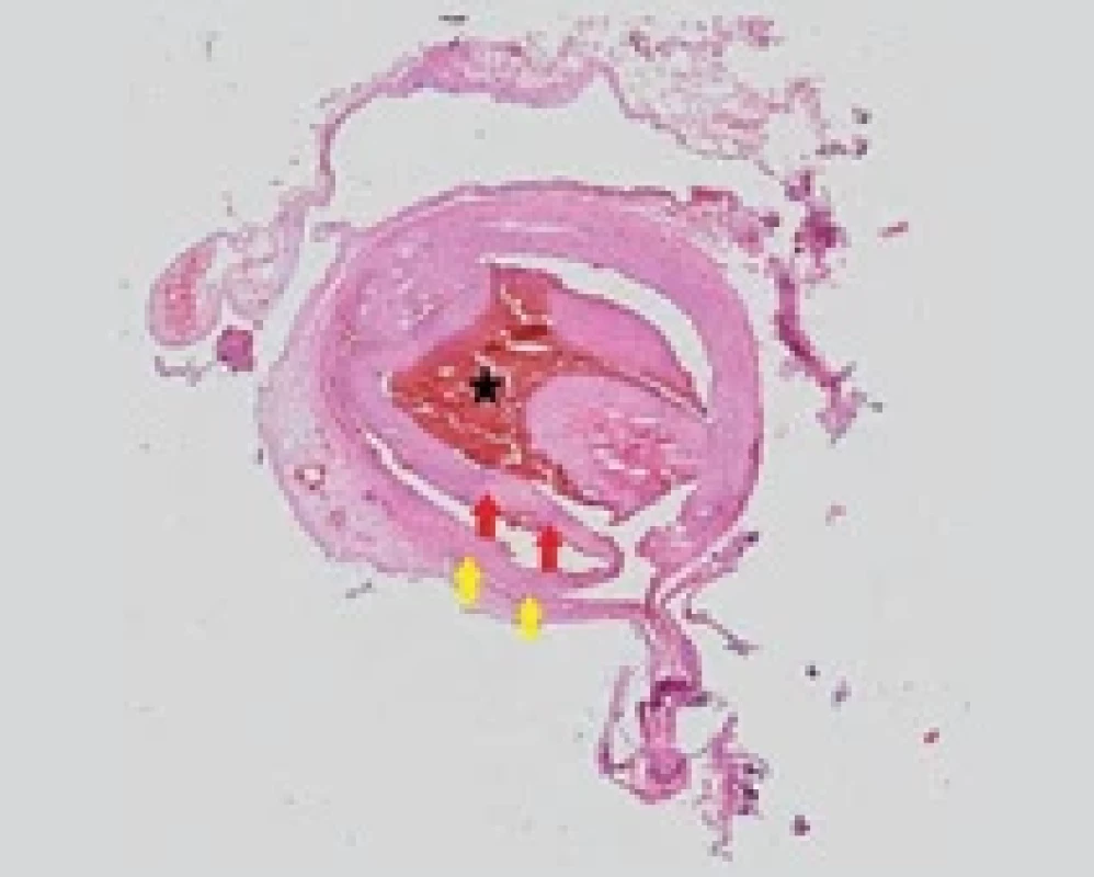Histological examination of the vertebral arteries stained with hematoxylin- eosin, revealing wall separation and surrounding changes. The medial layer of the vertebral artery (yellow arrows) shows intimal dissection, leading to compression of the true lumen (red arrows) and the presence of an intramural hematoma (black star).