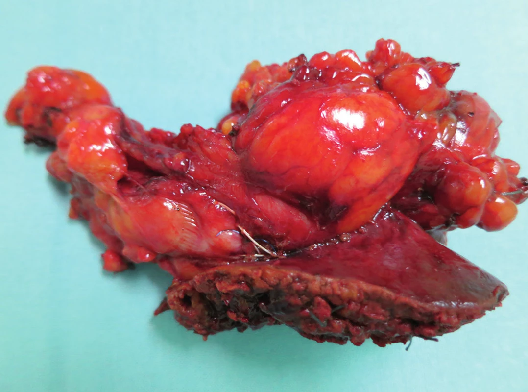 Žlučník s resekovaným lůžkem
Fig. 3: Gall bladder with resected bed