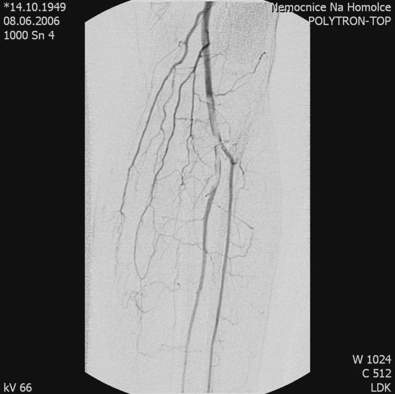 Angiografický obraz embolického uzávěru distální arteria poplitea a odstupu arteria fibularis. Embolus je tvořen tkáňovým lepidlem
Pic. 1. Angiography of the embolic closure of the distal popliteal artery and the fibular artery branch. The embolus is made of tissue glue