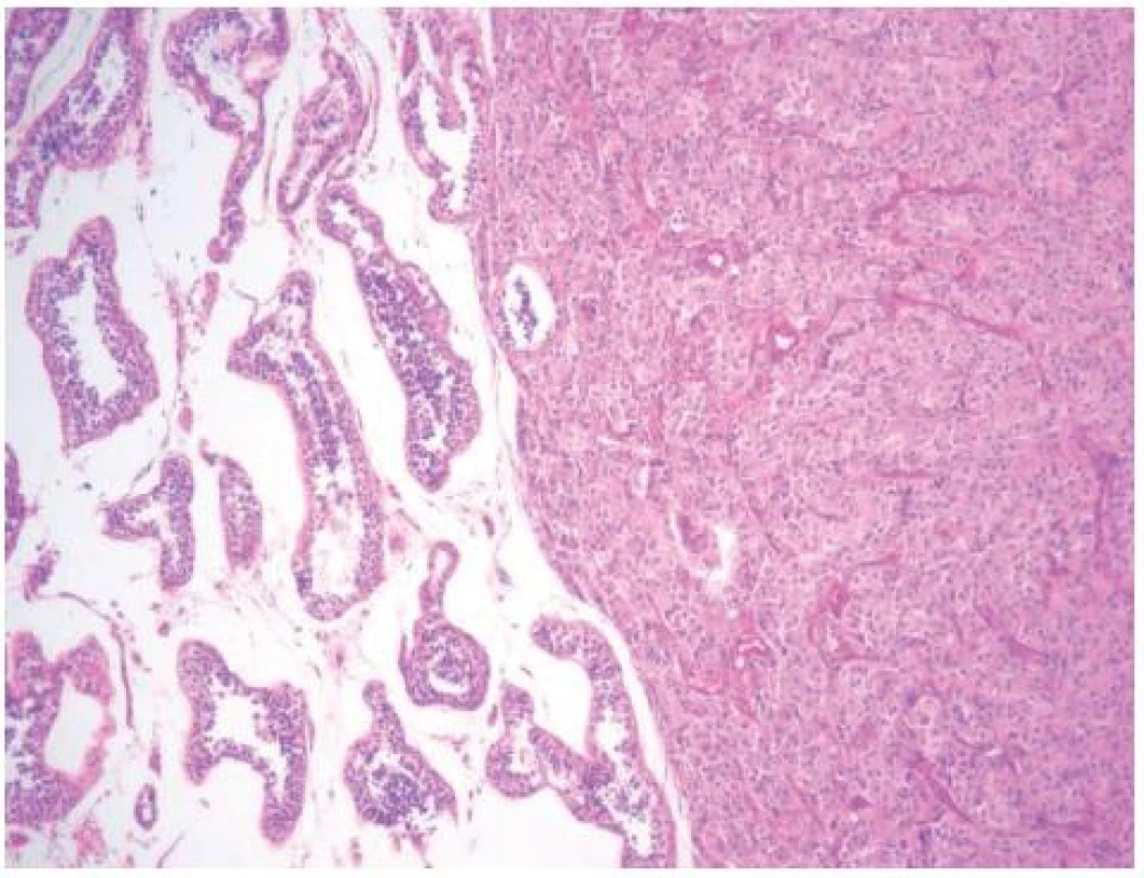 Vpravo patrný nádor z Leydigových buněk, vlevo normální parenchym varlete
Fig. 1. Right side, Leydig cell tumor; left side, normal parenchyma of the testis