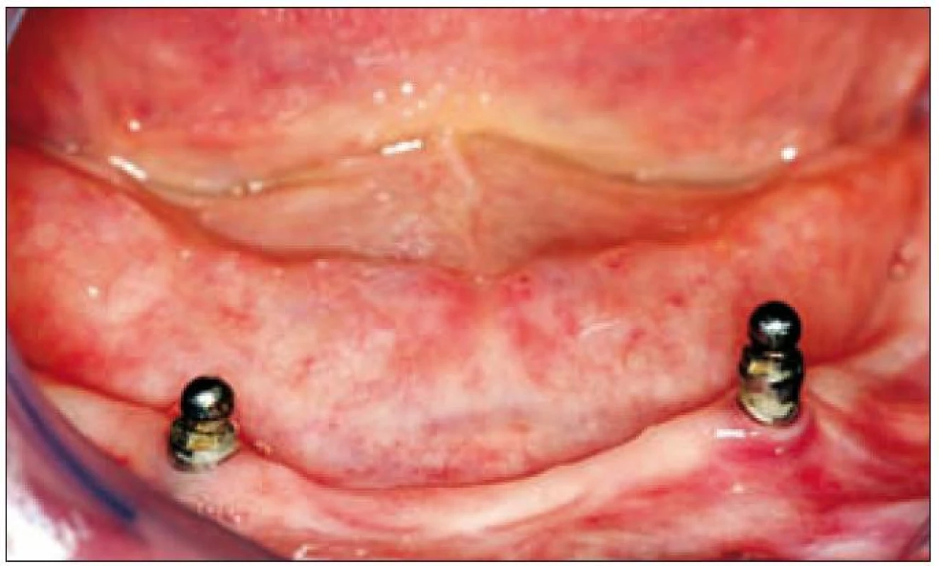 Dva enoseální implantáty zavedené do bezzubé dolní čelisti, které nesou hybridní snímací náhradu.
