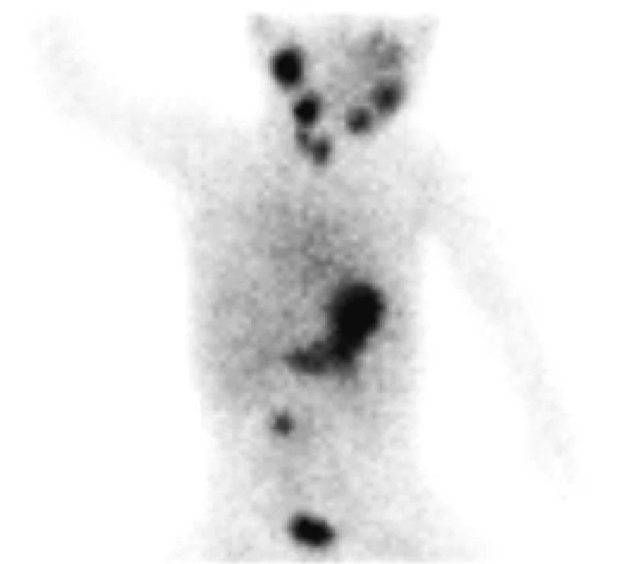 Scintigrafický (gamagrafický) nález krvácajúcej sliznice v pravom hypogastriu cca 10–15 minút po aplikácii 99mTcO4-
Fig. 3. A scintigraphic (gammagraphic) finding of the bleeding mucosa in the right hypogastrium, approx. 10–15 minutes following application of 99mTcO4-