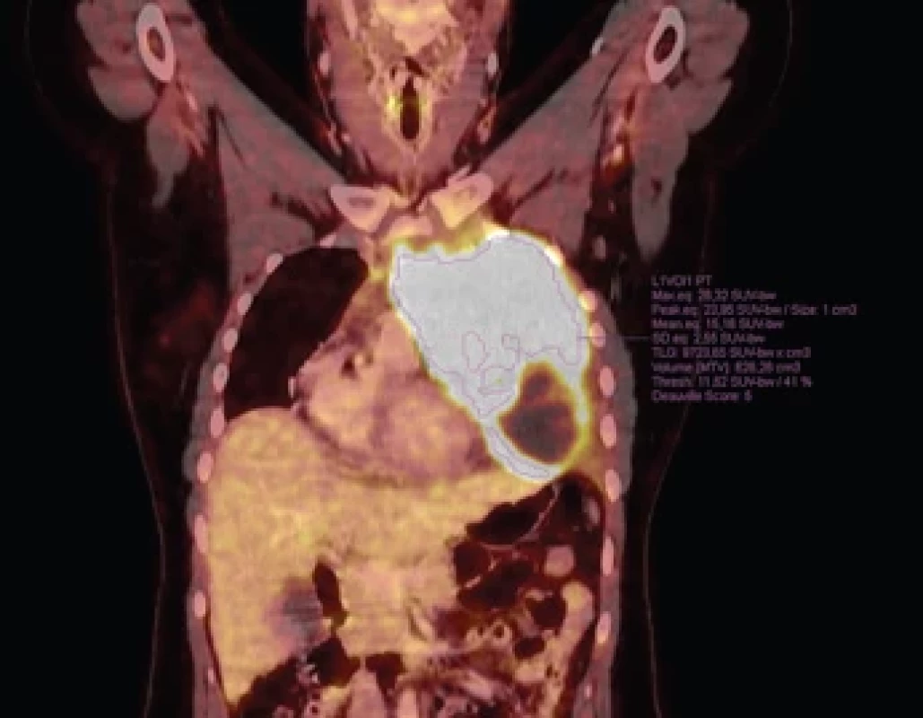 Demonstrace měření a vyhodnocení parametrů PET/CT pomocí softwaru, linkou ohraničena nádorová masa.