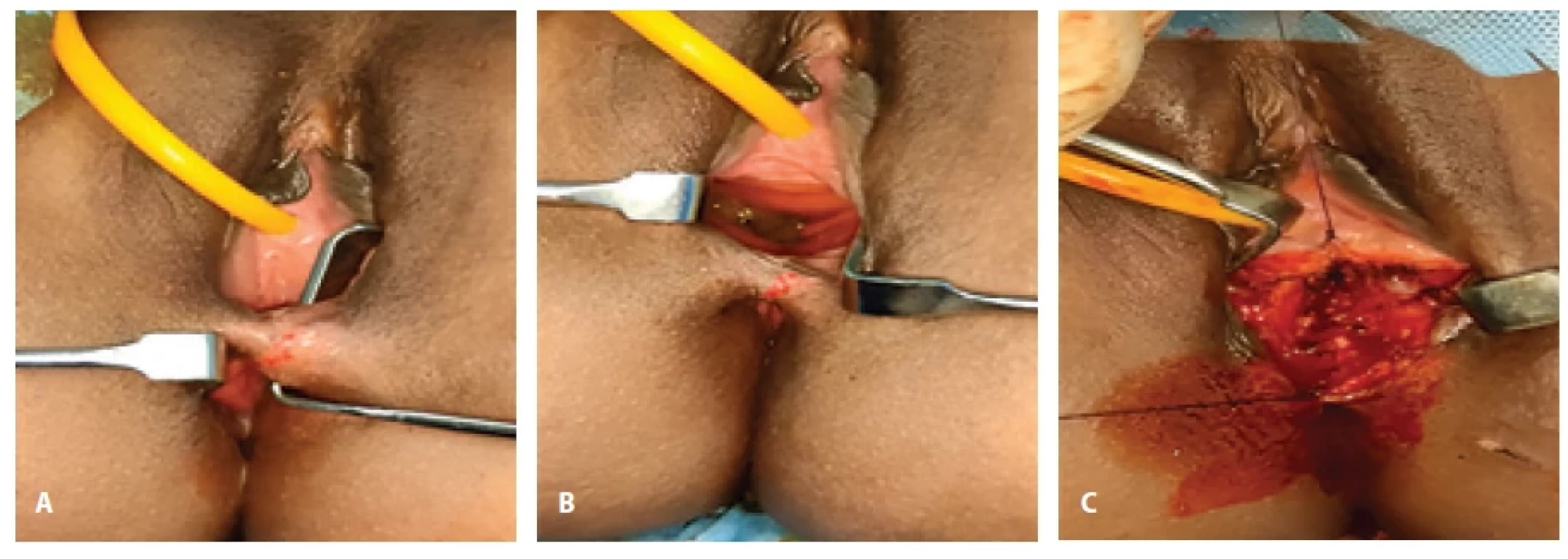 A) MRKH type 1: pre-operative image showing vaginal opening; B) pre-operative image showing recto-vaginal fi stula; C) intra-operative image showing separation of vaginal as well as rectal wall.