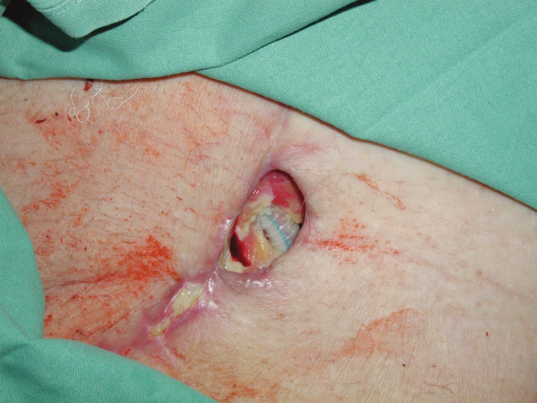 Dehiscence rány v levém třísle s nekrózami a obnaženou PTFE protézou
Fig. 1. A wound dehiscence in the left groin with necroses and an exposed PTFE prosthesis
