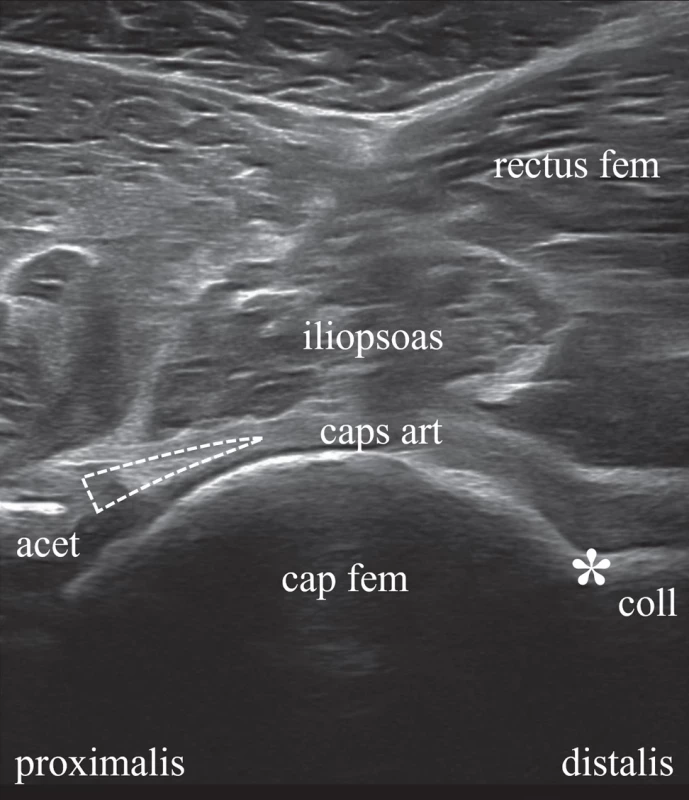 Sonogram kyčelního kloubu, fyziologický nález. Fig. 4. Sonogram of the hip joint, physiological fi nding.