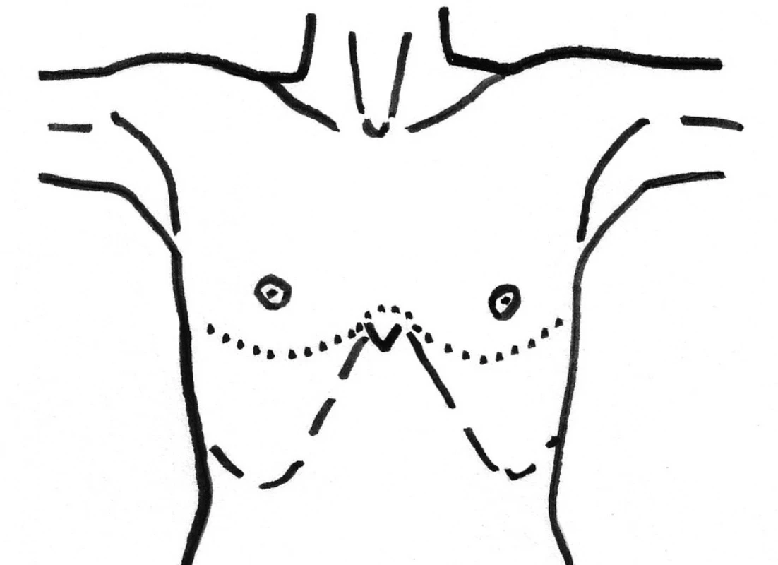 Clamshell incision, řez označen tečkovaně
Fig. 5. Clamshell incision, the incision is marked by a dotted line