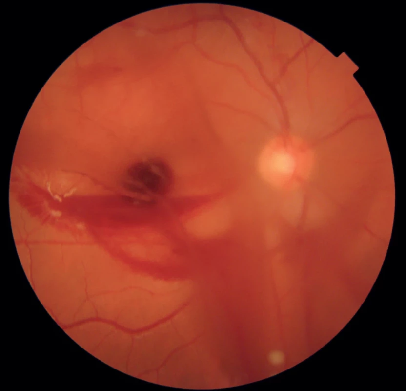 Photo of the fundus after two days, with gradual absorption of bleeding