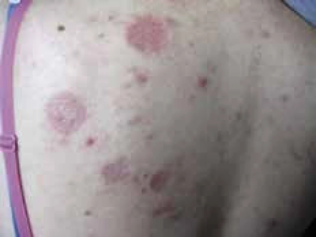 Necrobiosis lipoidica, generalizovaná forma u pacientky s DM1T