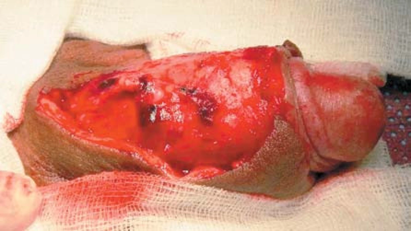 Excize léze z dorza penisu
Fig. 2. Excision of the ulcerative lesion of the dorsum of the penis