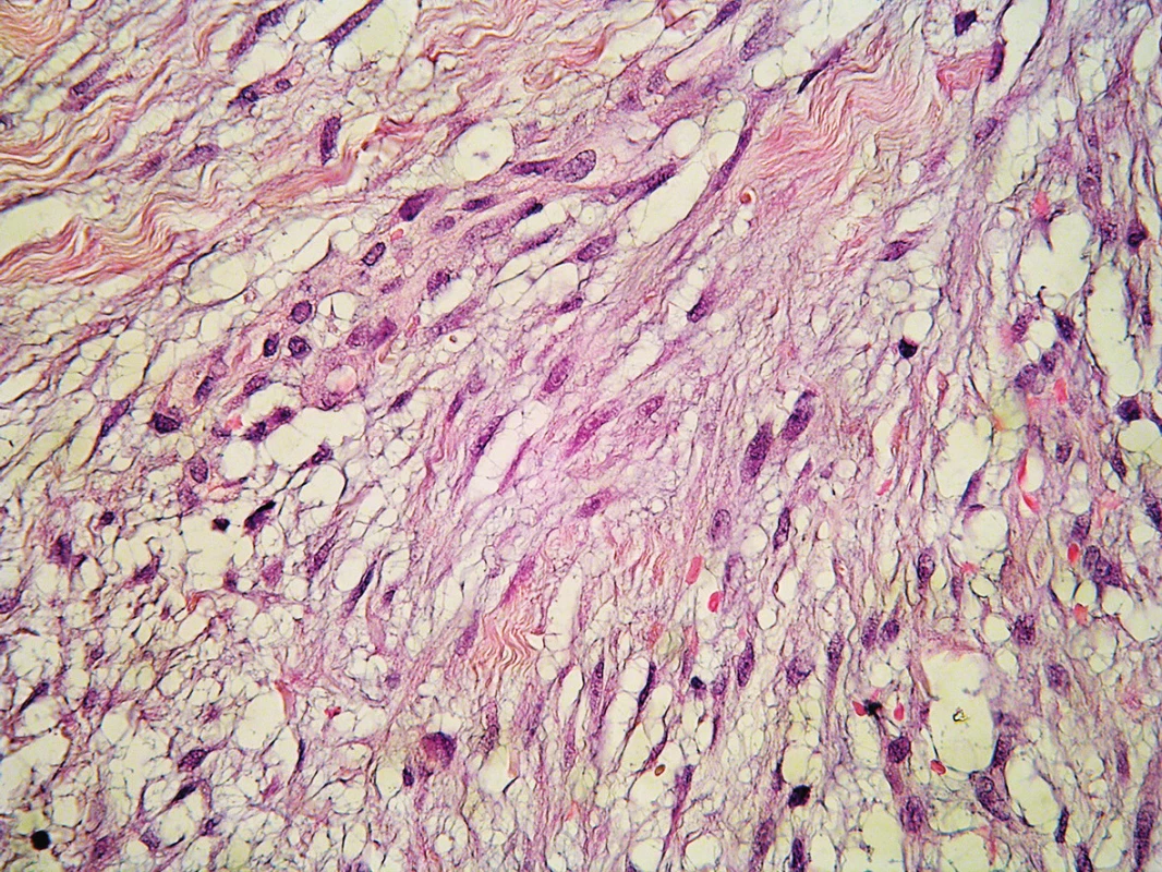 Buňky mají hypochromní monomorfní jádra a podobají se fibroblastům či myofibroblastům