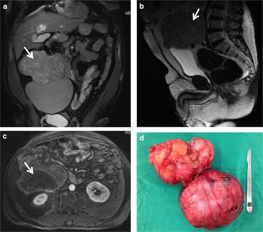 Solitary fibrous tumor from this patient. <b>a</b> MRI appearance of the mass in the coronal plane shows 18.6 cm in maximal diameter. <b>b</b> MRI T2-weighted image in the sagittal plane demonstrates the retroperitoneal location of the tumor. <b>c</b> contrast-enhanced MRI transverse plane indicates a lobulated tumor with solid and cystic componentes. <b>d</b> Photograph of the dissected specimen weighing 1.5 kg presents two nodular masses measuring 14.3 and 13 cm with irregular shape and connected by a fibroadipose tissue. There were extensive areas of necrosis