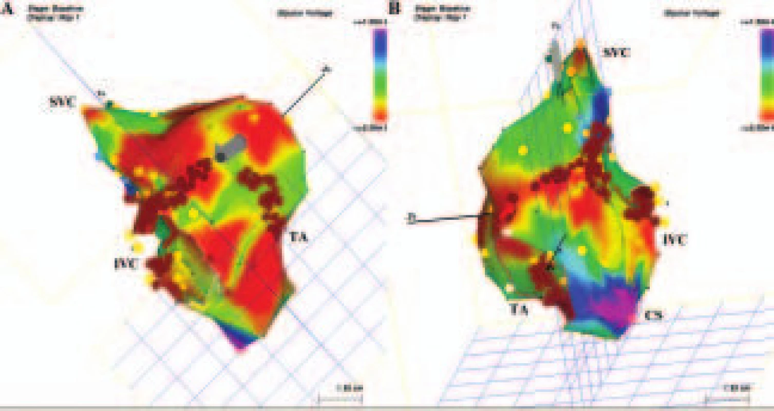 Anatomický přístup k ablaci nemapovatelných SMRT s lineárními lézemi v pravé srdeční síni. 
Voltážová elektroanatomická mapa pravé srdeční síně, v níž červená barva znázorňuje místa s elektrickými potenciály nižšími než 0,5 mV a fialová barva místa s elektrickými potenciály přesahujícími 1,5 mV. A. V pohledu na inferolaterální stěnu pravé síně jsou dvě lineární léze spojující elektricky němou oblast (jizvu) (označenou šedou barvou), jednak k ústí dolní duté žíly, a jednak k trikuspidálnímu prstenci. Místa jednotlivých aplikací RF energie jsou označena hnědými body. B. Při pohledu ze septální strany je vidět posteriorní lineární lézi spojující dolní a horní dutou žílu a další lineární lézi vedenou k horní části trikuspidálního prstence. Další lineární léze byla provedena konvečně napříč subeustachovským můstkem. Kromě voltážové mapy je umístění strategických lineárních lézí voleno podle lokalizace pozdních potenciálů při sinusovém rytmu nebo při stimulaci síní a podle diastolických potenciálů, které se podaří lokalizovat konvečním mapováním při tachykardiích, které přetrvávají dostatečně dlouho (minuty).