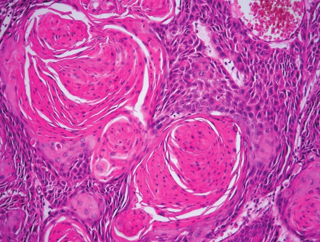 Obr. 3. Nenádorové, prekancerózní a nádorové léze vulvy sdružené v HPV negativní cestě karcinogeneze.
A – LS (HE, 100x); B – LSC (HE, 40x); C – pfiechodová zóna mezi LSC a d-VIN (HE, 200x); D – d-VIN (HE, 40x); E – d-VIN (HE, 400x); F – SCC keratinizující (HE, 200x)