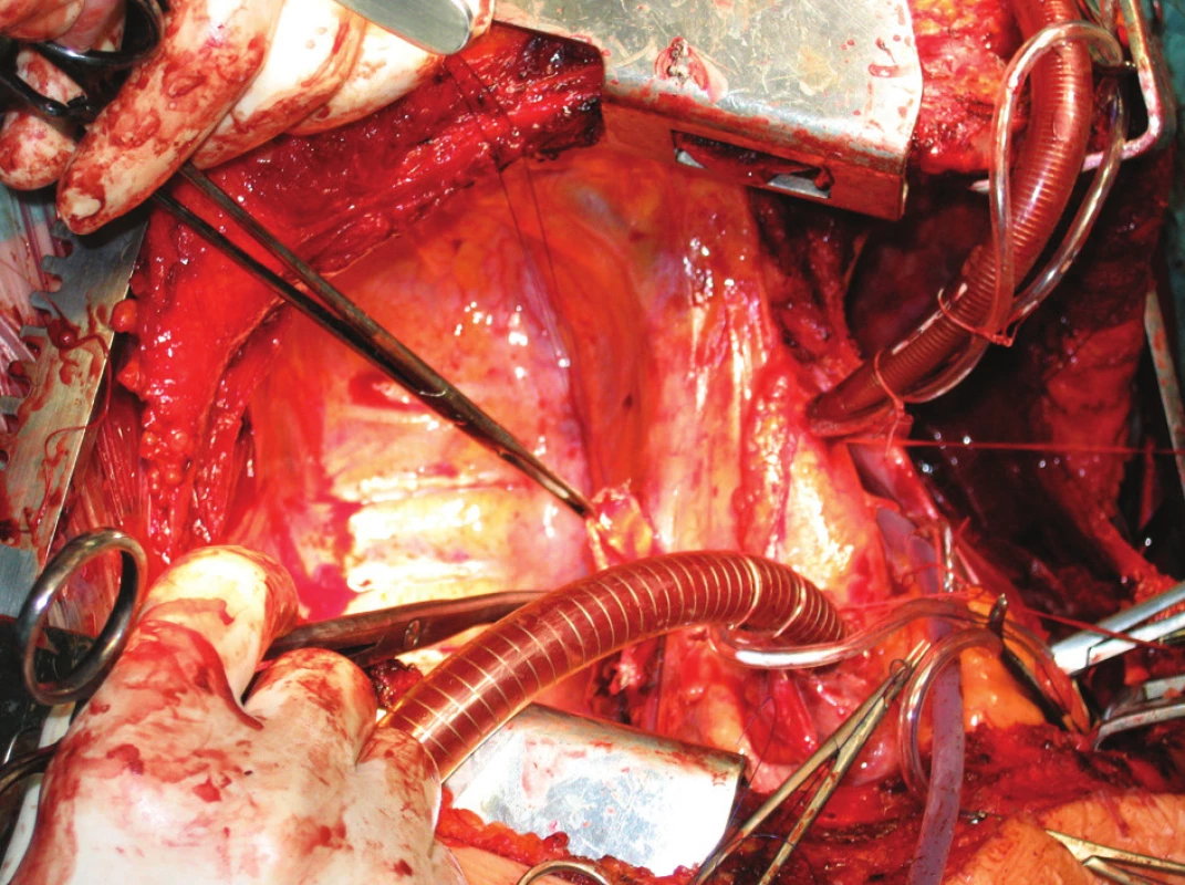 Technika transplantace plic, stav před implantací
Fig. 4. Lung tansplantation technique, the condition prior to the procedure