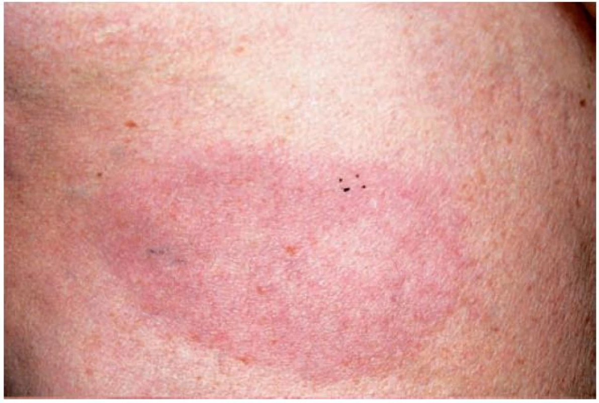 Granuloma anulare – erytematózní forma
(Dermatovenerologická klinika 1. LF UK a VFN)