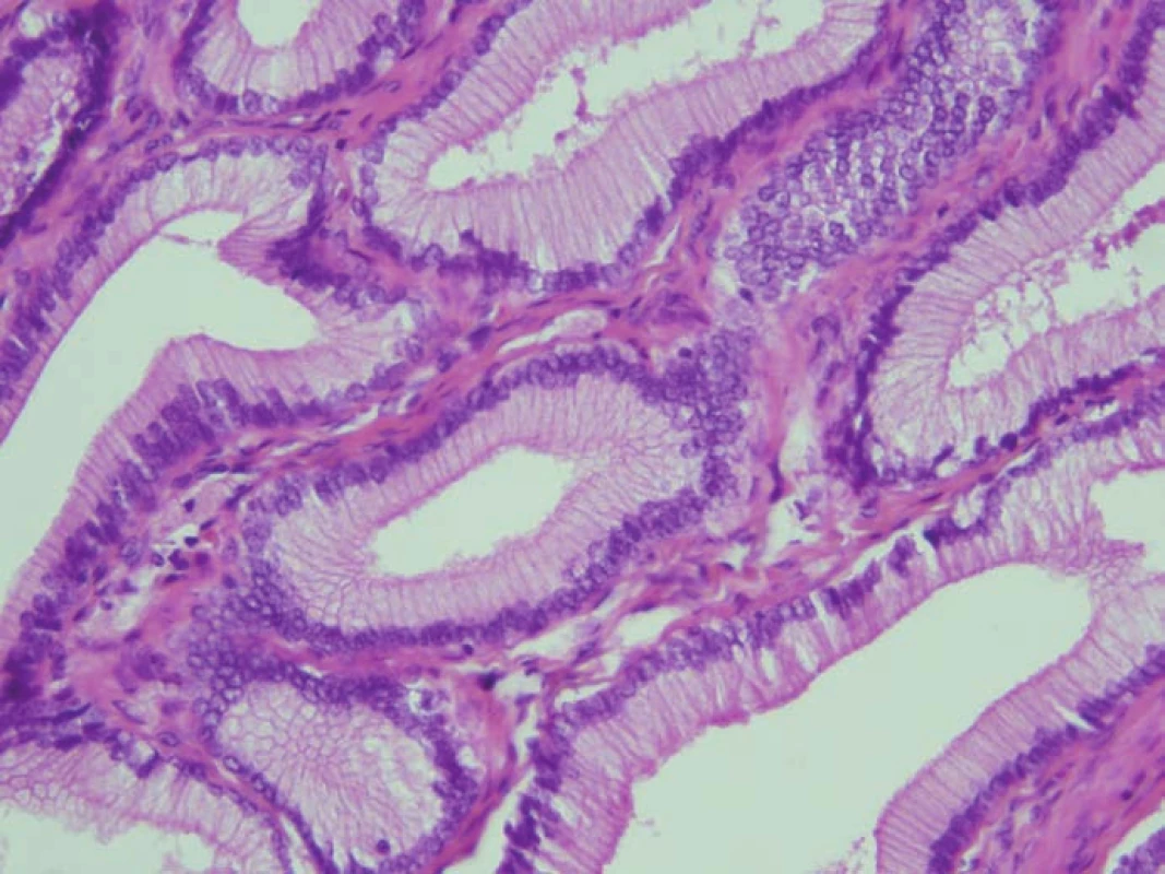 Histopatologické vyšetření.
Tubulopapilární adenom v barvení hematoxylin-eozin.
Fig. 4. Histopathological examination.
Tubulopapillary adenoma in hematoxylin-eosin.