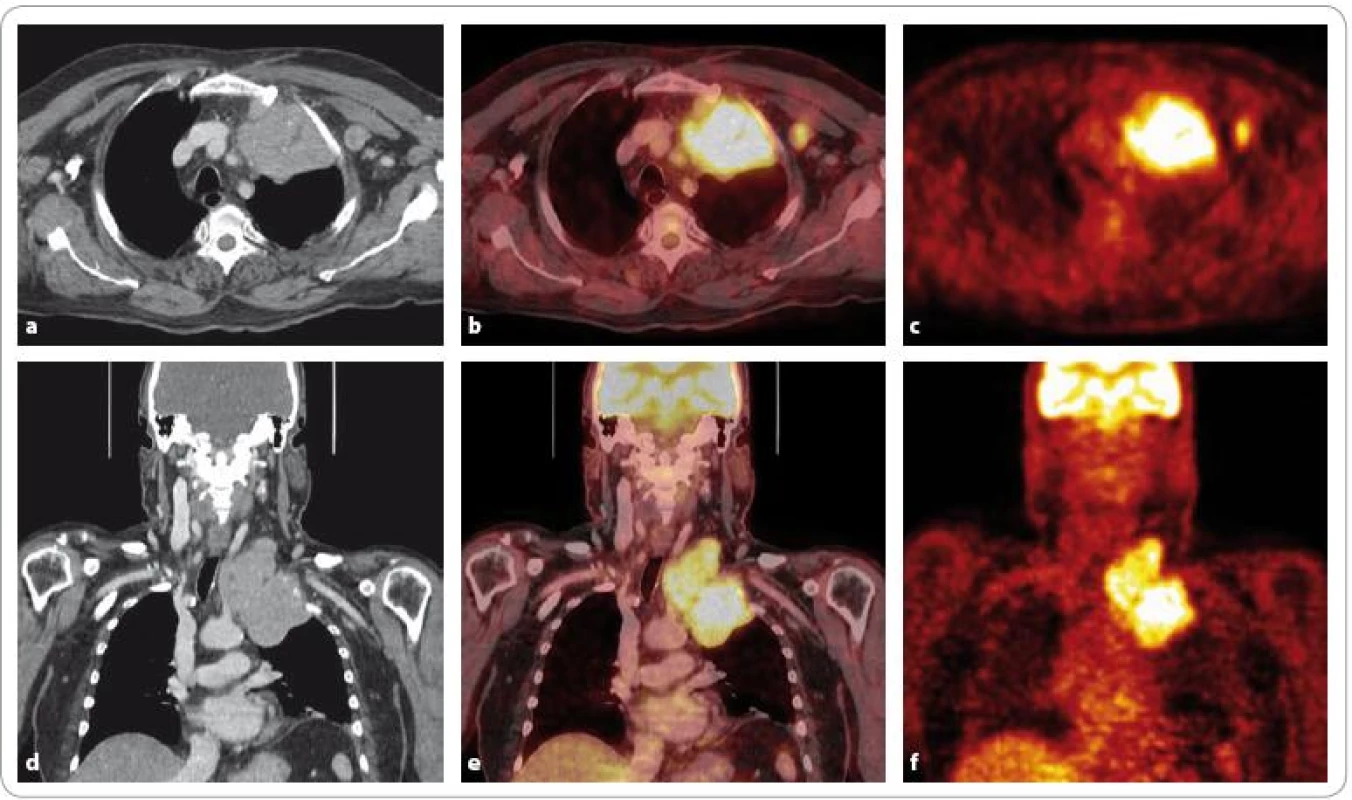 <sup>18</sup>F-FDG PET/CT u stejného nemocného jako na obr. 4. Lze diferencovat objemnou měkkotkáňovou masu v apexu levé plíce se supraklavikulárním zásahem vykazující zvýšenou akumulaci FDG a centrální fotopenii odpovídající patrně nekróze. Dále osteolýza ventrálního konce 1. žebra vlevo. Laterálně je patrná zvýšená konzumpce glukózy v axilární lymfatické uzlině. Ve srovnání s <sup>99m</sup>Tc-MIBI scintigrafií (obr. 4) bylo <sup>18</sup>F-FDG PET/CT vyšetření přínosnější.