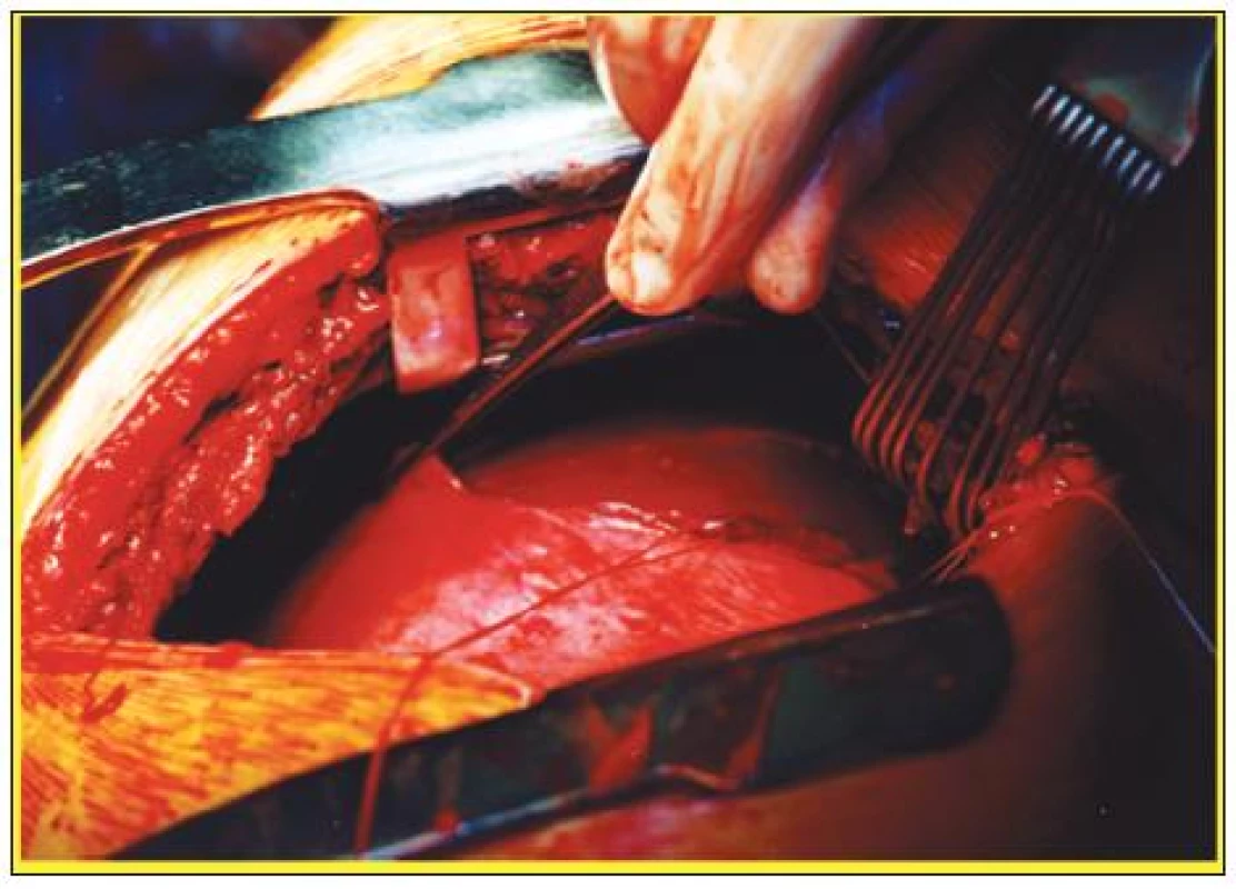 Peroperační snímek ruptury pravé poloviny bránice ošetřené suturou torakotomickou cestou
Fig. 3. Intraoperative view of the right-sided diaphragmatic rupture, managed by thoracotomy