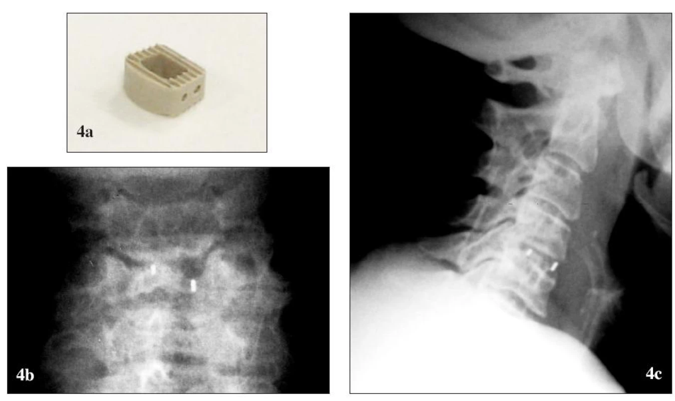 PEEK-ová náhrada medzistavcovej platničky CornerstoneTM PSR (Medtronic Sofamor Danek). (a) pred implantáciou, (b) po implantácii, RTG (b1) predná a (b2) bočná projekcia