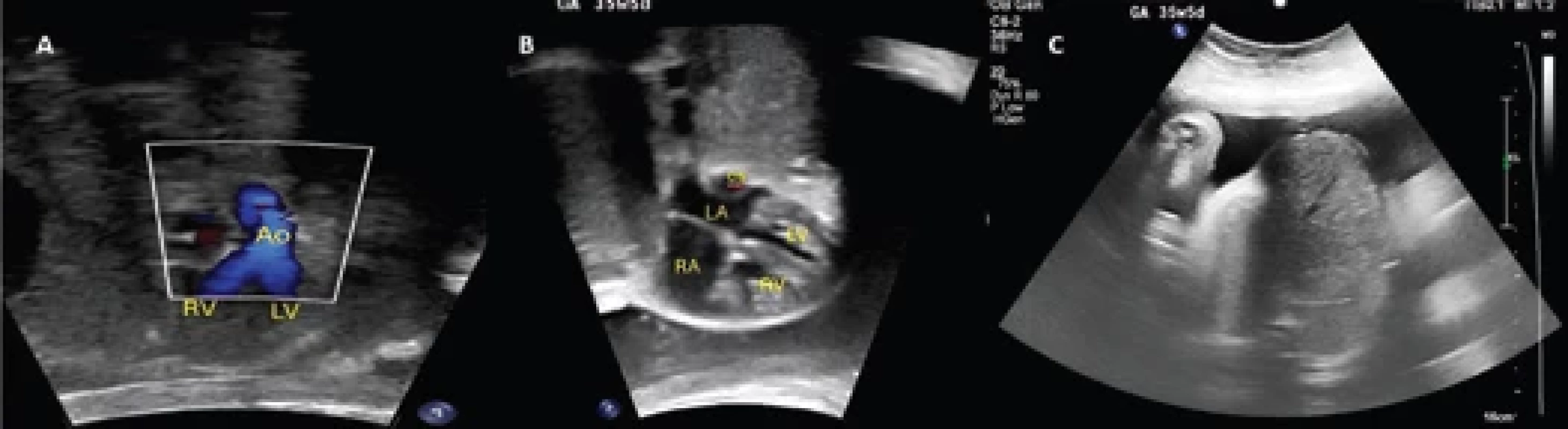 Fetal echocardiogram showing ventricular septal defect type malaligned with overriding aorta 50% of interventricular septum using color Doppler (A) and normal four-chamber view with dilated coronary sinus and ectopia cordis (B). Axial section of the upper abdomen showing an omphalocele by ultrasound (C).