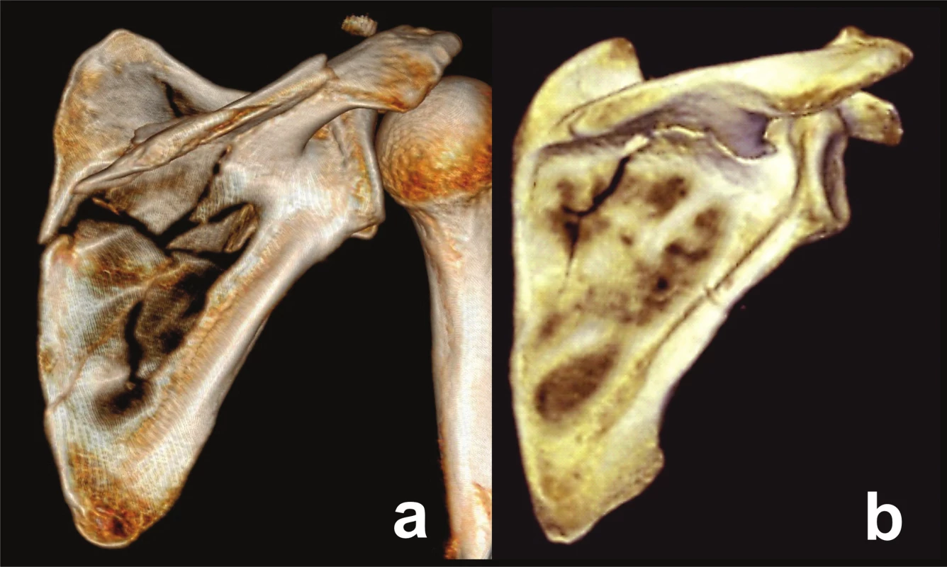 Types of spinal pillar fractures
a – fracture line passes through the central weakened area; b – scapular spine broken off the scapular body.