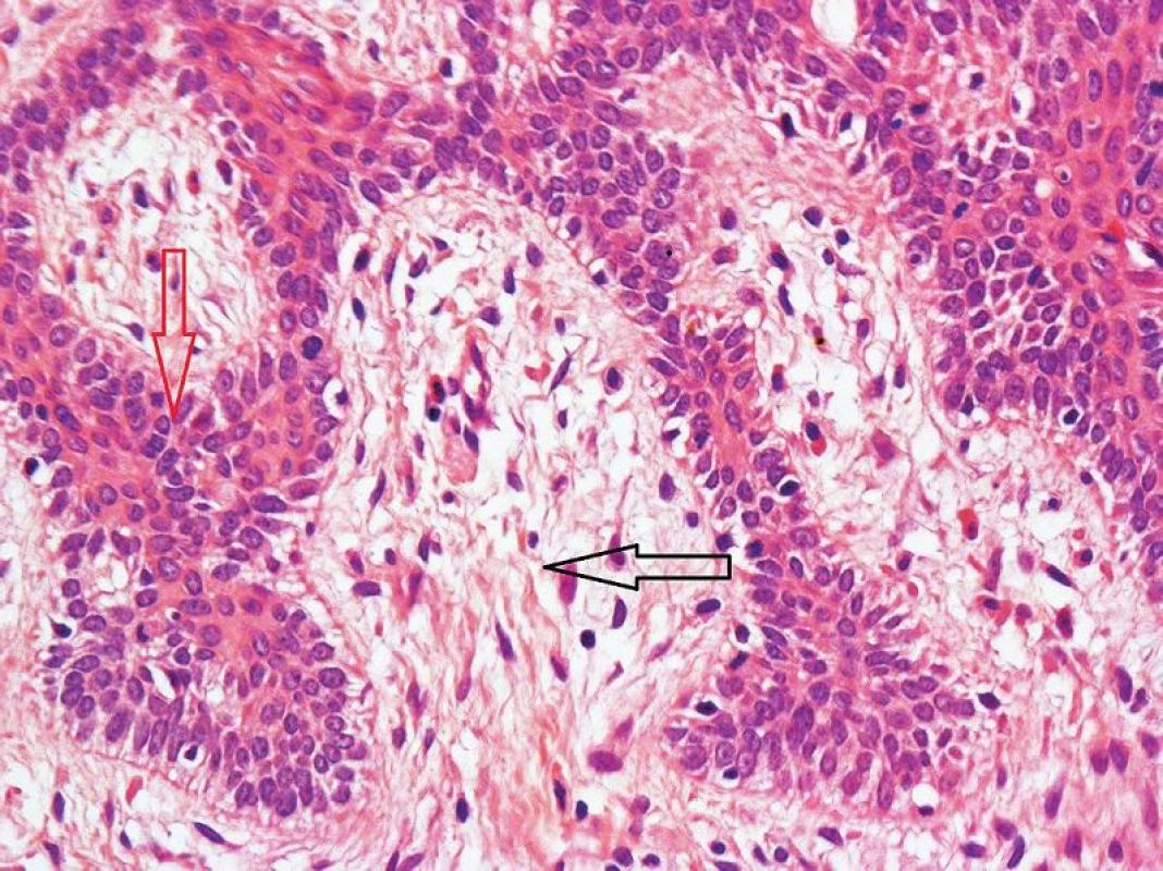 Fibroepitelióm (HE 200x)
