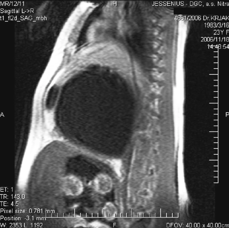 MR nález dutiny brušnej znázorňujúce cystu a plod
Pic. 3. MR intraabdominal finding depicting a cyst and a foetus