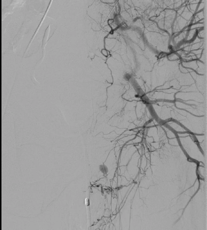 <i>Angiografie – leak z a. iliaca interna l. sin</i>
Fig. 4. <i>Angiography – leak from left internal iliac artery</i>