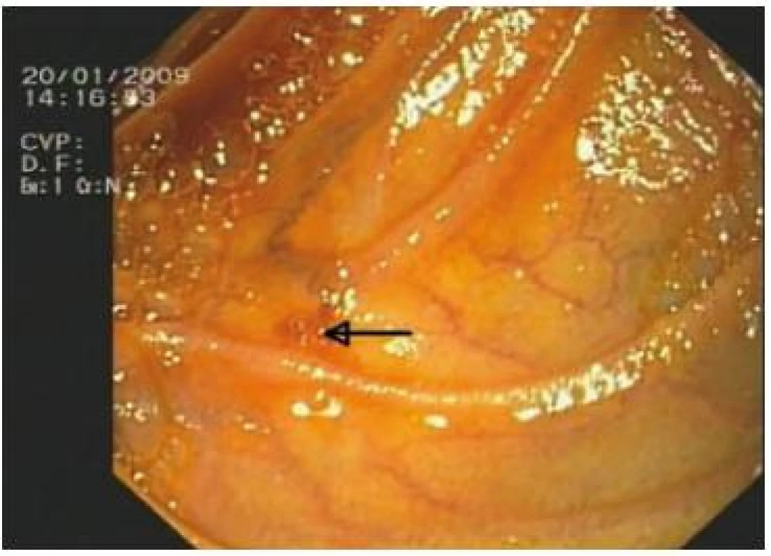 Endoskopický pohled na nenápadné vyústění stenotizované HJA v přívodné kličce cca 5 cm pod jejím zaslepeným koncem. Označeno šipkou.
Fig. 3. Endoscopic view of an unobtrusive opening of stenotic HJA in the inlet loop about 5 centimeters below its blinded end. This is designated by an arrow.