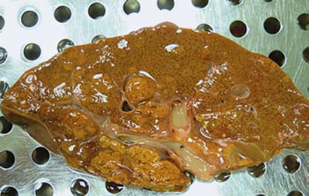 Multifokální hepatocelulární karcinom. Na řezu jsou patrny uzly žlutohnědé barvy místy splývající.
Fig. 2. Multifocal hepatocellular carcinoma. In the section there are visible nodes of yellow-brown colour, confluent at some places.
