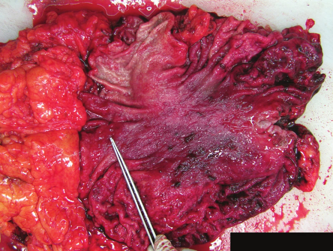 Preparát žaludku s infiltrací adenoneuroendokrinním karcinomem
Fig. 1: Gastric specimen – infiltration with mixed adenoneuroendocrine carcinoma