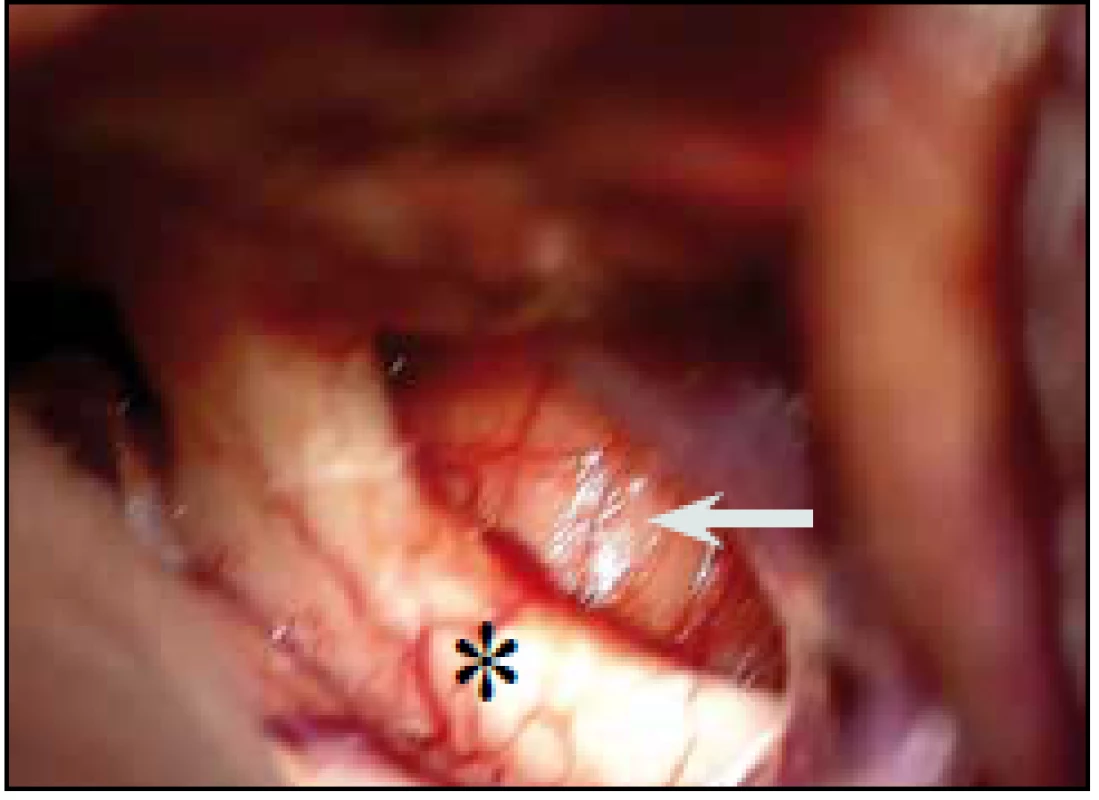 Peroperační snímek, tumorózní expanze infundibula (šipka) s lehkým útlakem pravostranného optického nervu a chiasmatu (hvězdička).
Fig. 4. An operating view showing the tumor of the infundibulum (arrow) compressing the right optic nerve and optic chiasm (asterisk).