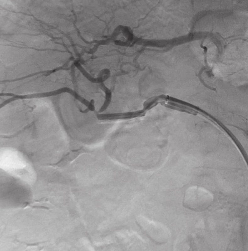 AG po zavedení stentgraftu s vymizením leaku a dobrým průtokem skrze a. hepatica
Fig. 4: Angiography after stentgrafting without leakage and good blood flow through hepatic artery