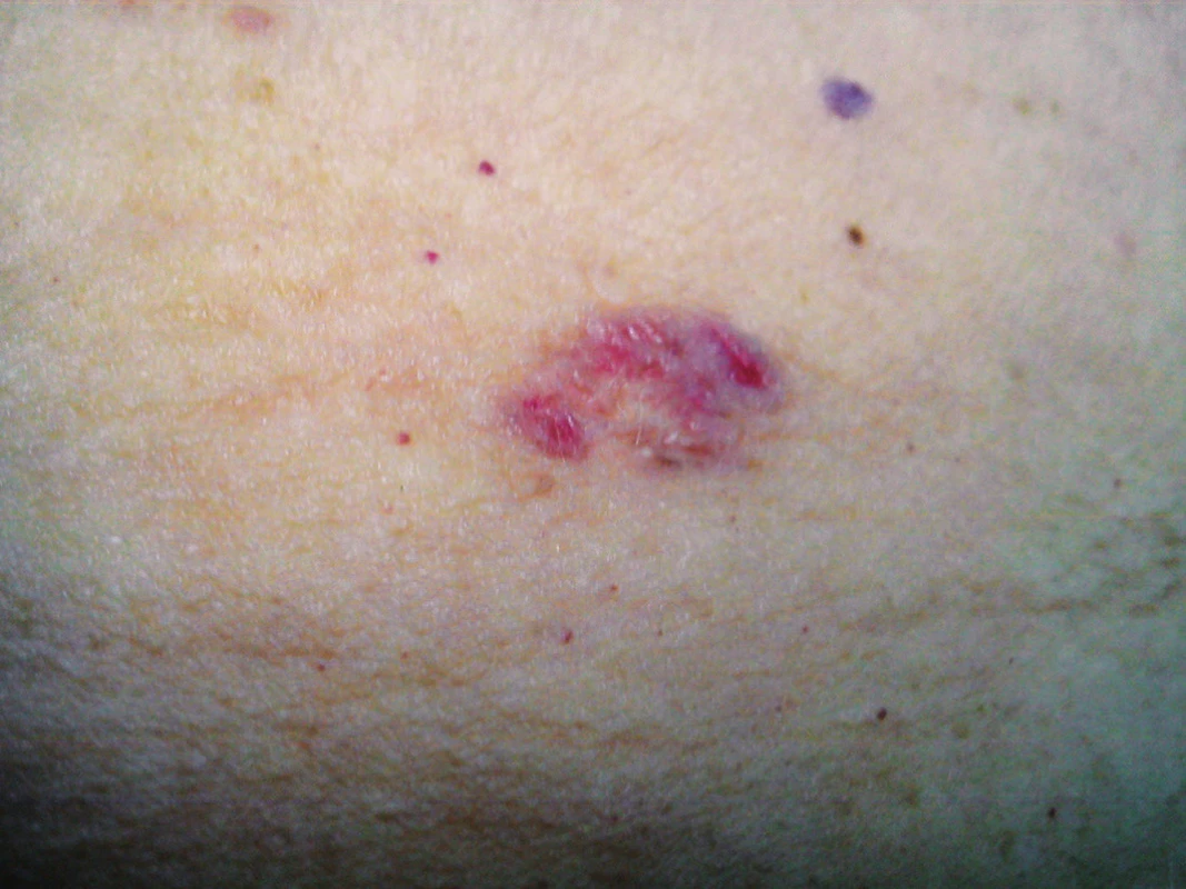 Fibroepitelióm