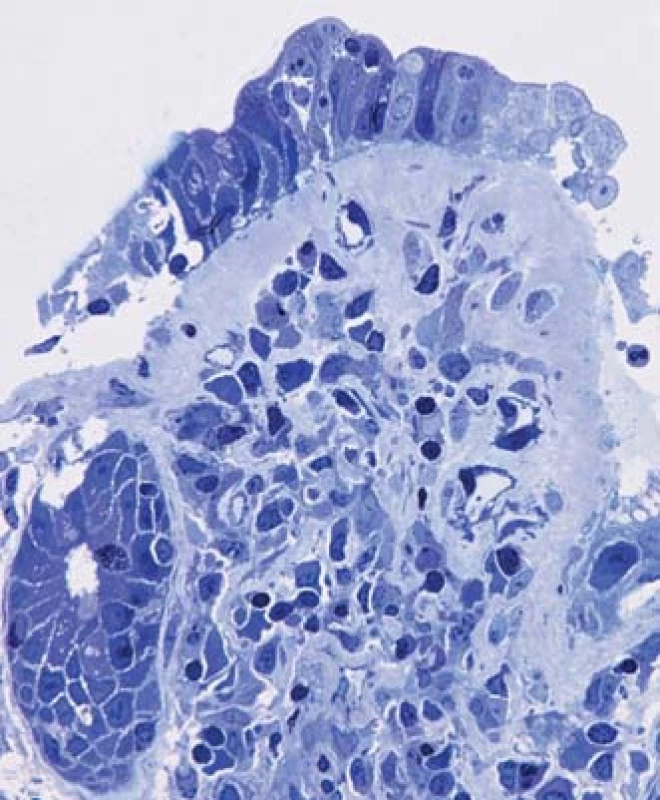 Histologický obraz sliznice terminálního ilea prokazující kromě těžké atrofie klků a subepiteliálního pruhu amorfního hyalinního materiálu také výraznou atrofii mikroklků (technika polotenkých plastových řezů, zvětšení 400×).
Fig. 5. Histology of terminal ileum mucosa revealing severe villous atrophy, subepithelial band of amorphous hyalin material and significant atrophy of microvilli (semi-thin plastic section, magnification 400×).