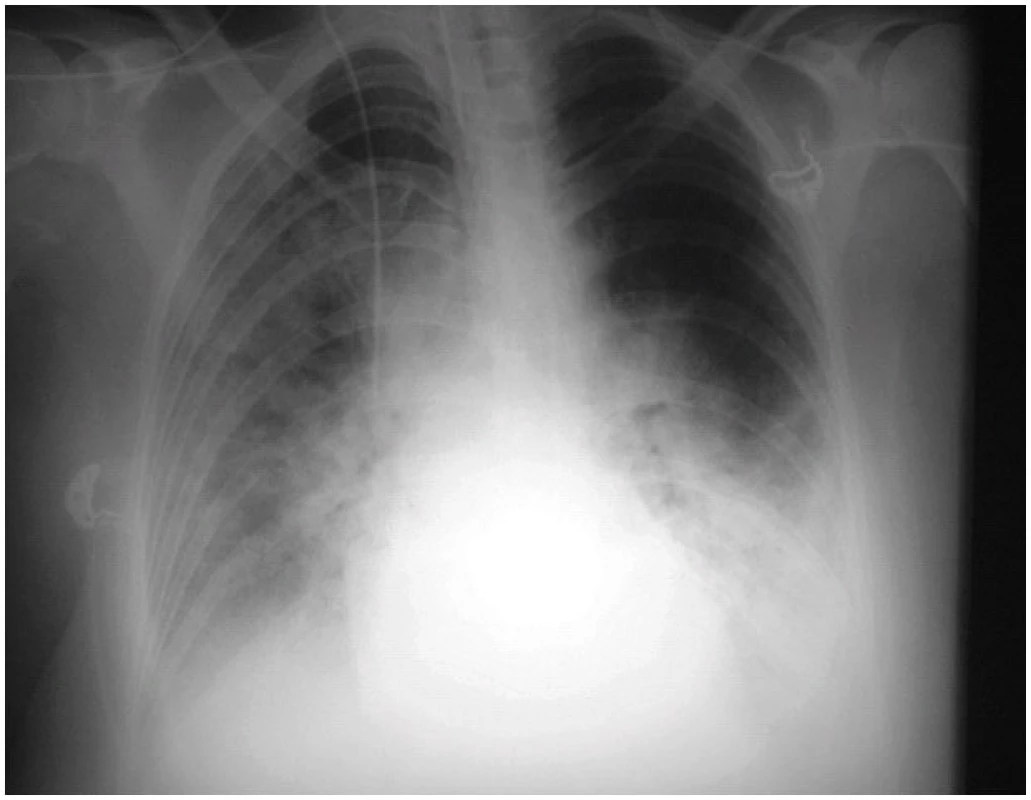 RTG snímek plic 56leté pacientky 1. den hospitalizace 
Nález popsán jako obraz oboustranného městnání v malém oběhu až charakteru kardiálního edému, při popisu kontrolního snímku po 2 dnech přehodnocen na oboustranné difuzní plicní infiltráty.