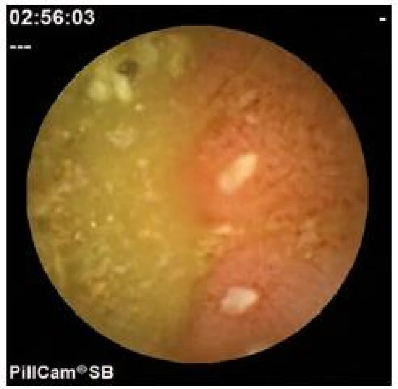 Podozrivý nález z vyšetrenia kapsulovou enteroskopiou.
Fig. 2. Inconclusive finding using capsule enteroscopy.