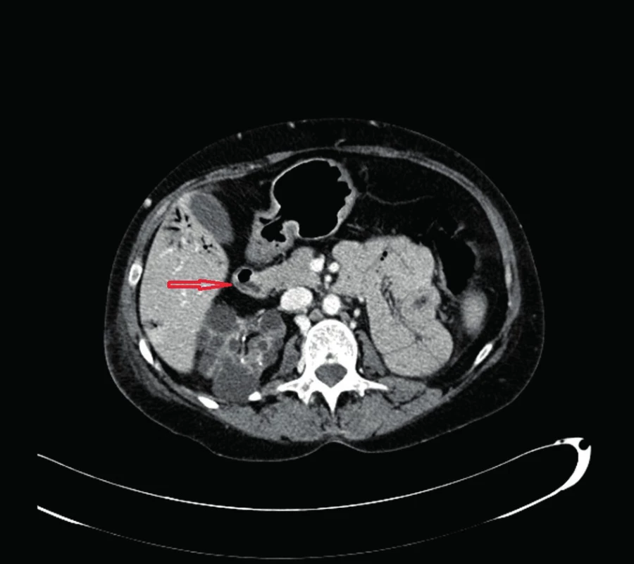 Pneumatoza žlčovodu
Fig. 3: Pneumatosis of the biliary tree