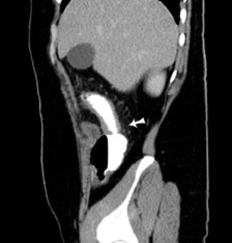 CT sagitálny rez: šípka označuje pôvodne suponovanú stenózu ileoascendentnej anastómózy.
Fig. 4. CT of sagital cross-section: arrow indicates originally supposed stenosis of the ileoascendental anastomosis.