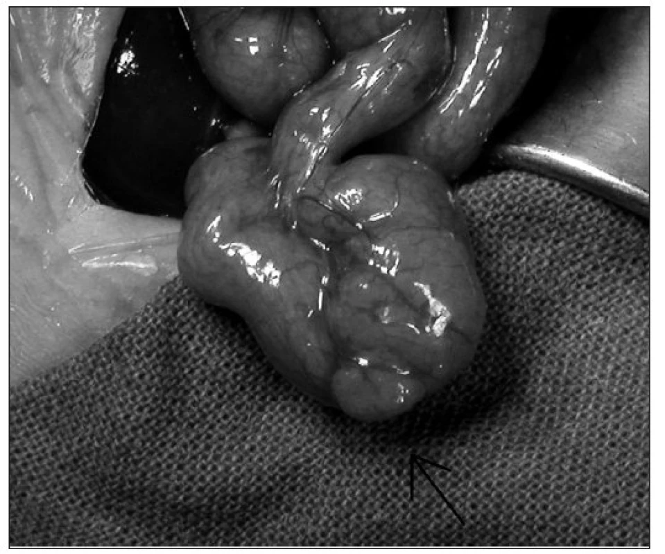 1. Makroskopický obraz heterotopie žalúdočnej sliznice v stene duodena.
Fig. 1. Macroscopic picture of stomach mucosa heterotopy of duodenal wall.