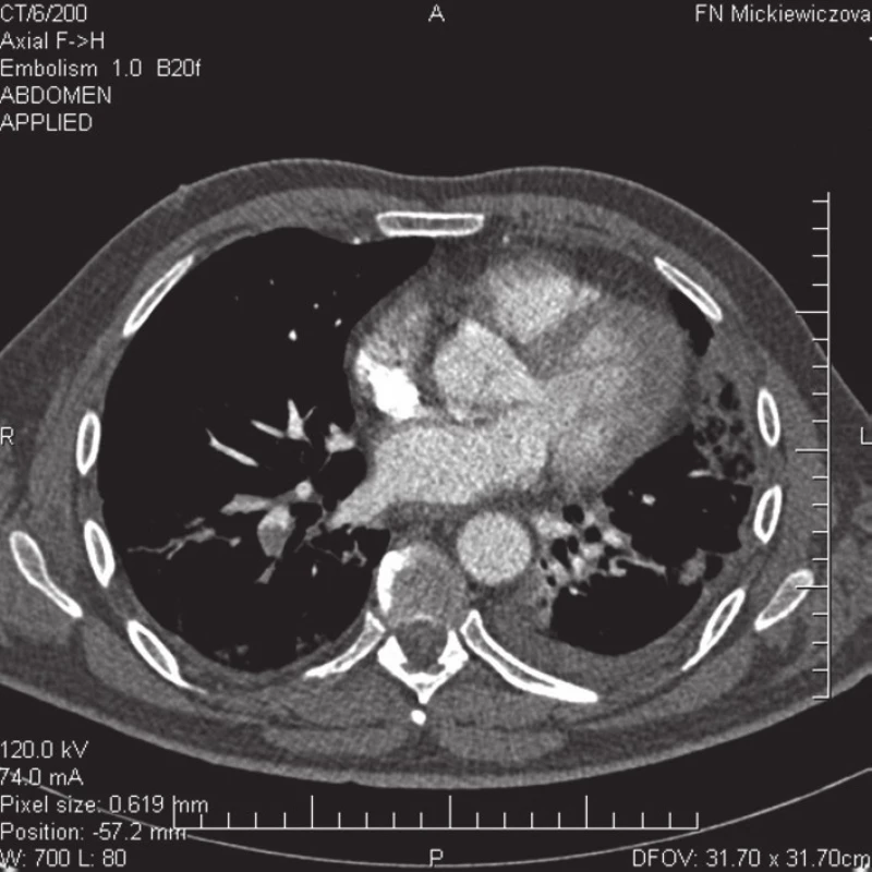 CT pulmangiografia – embolizácia do segmentálnych artérií a. pulmonalis pre dolný lalok vpravo a v oblasti linguly vľavo.